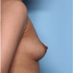 Breast Lift with Implant Before & After Patient #34302